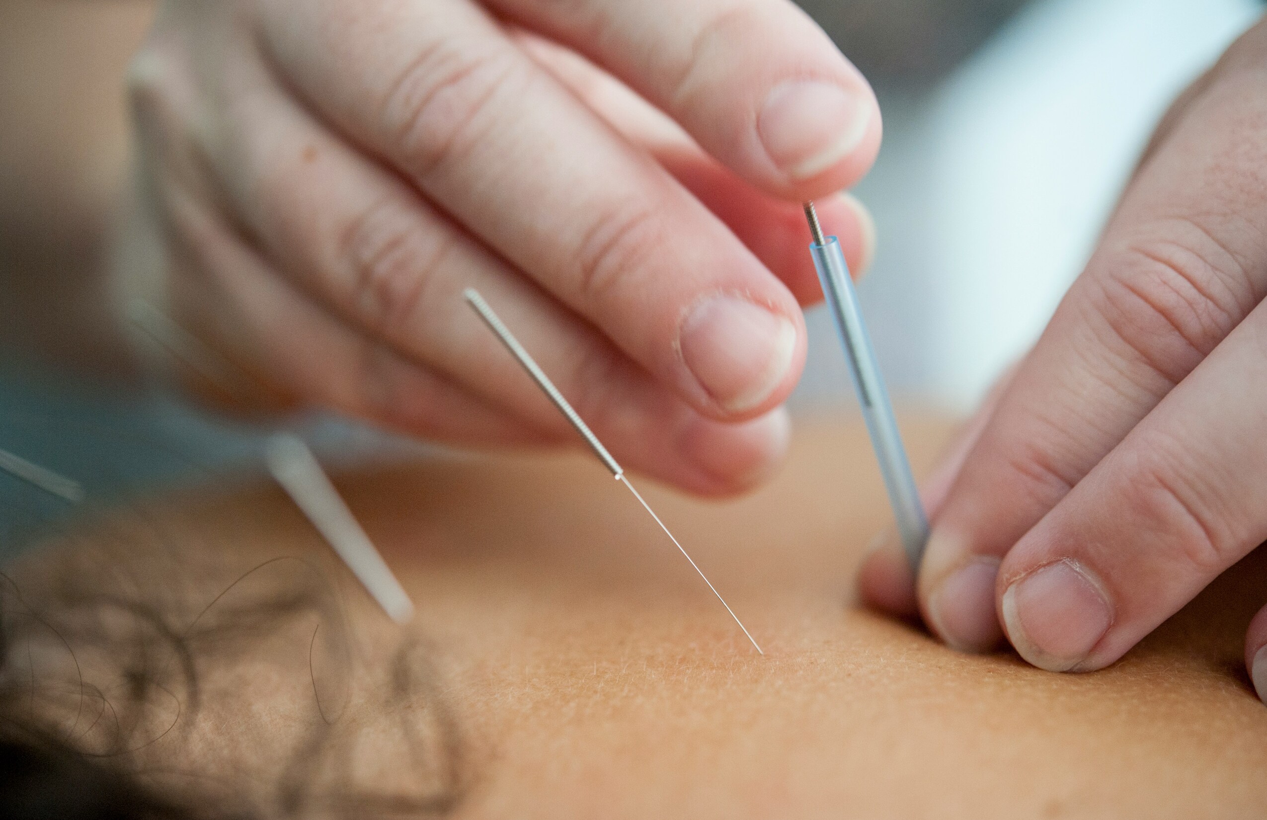 acupuncture needles images