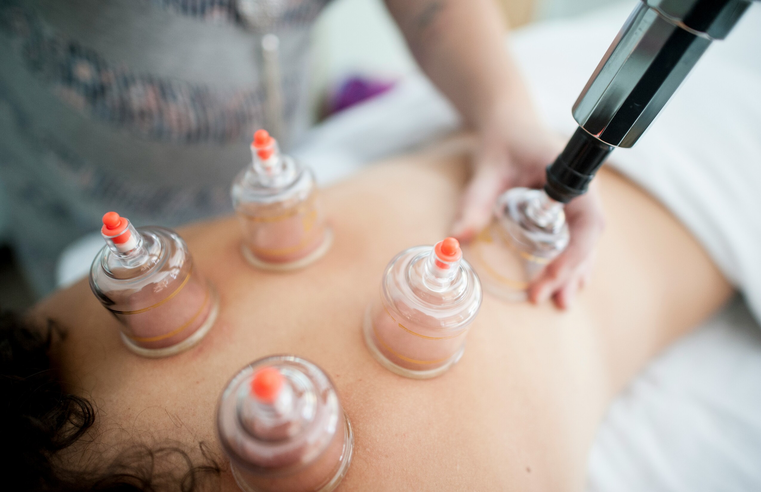 cupping images